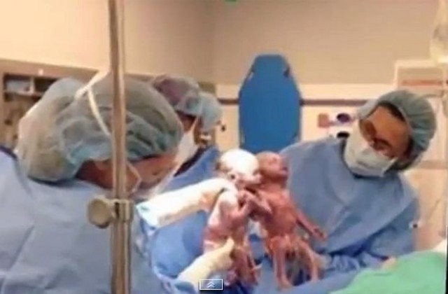 Близнаци се родиха хванати за ръце