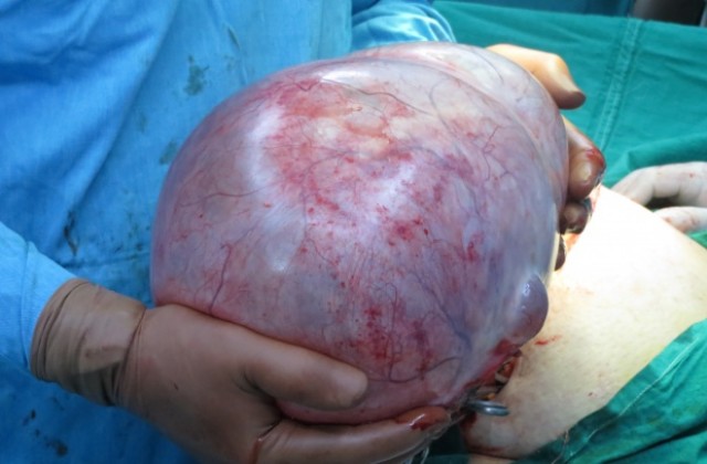 Огромна  киста на яйчника отстраниха лекари от пазарджишка болница