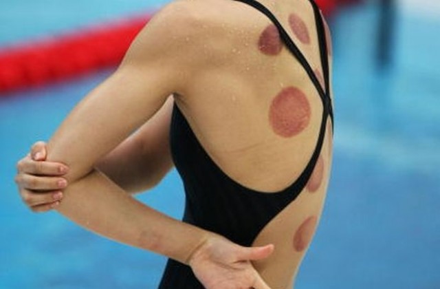Какви са странните петна по гърбовете на някои олимпийски спортисти (СНИМКИ/ВИДЕО)