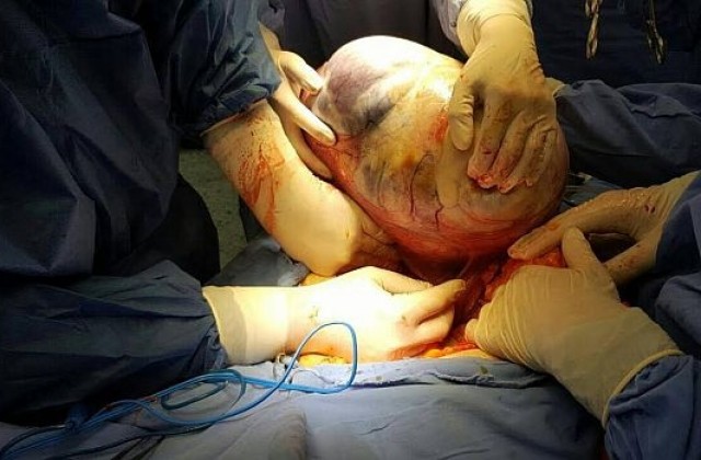 12-килограмов тумор извадиха от пациентка лекарите от екипа на проф. Горчев в МБАЛ„Света Марина