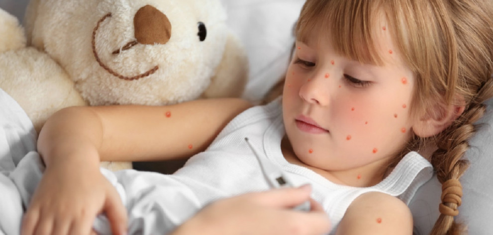 Спешно трябва да се имунизират децата срещу морбили