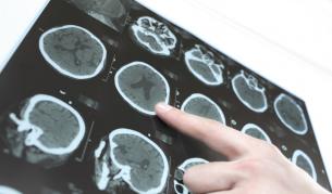 Учени установиха "срока на годност" на човешкия мозък