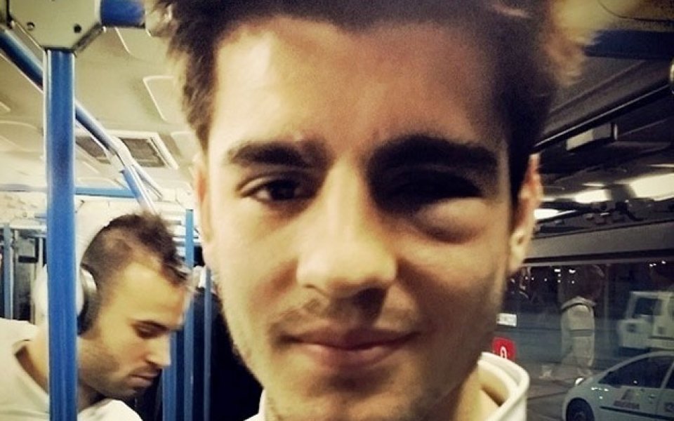 Младок от Реал с посинено око от гостуването в Памплона