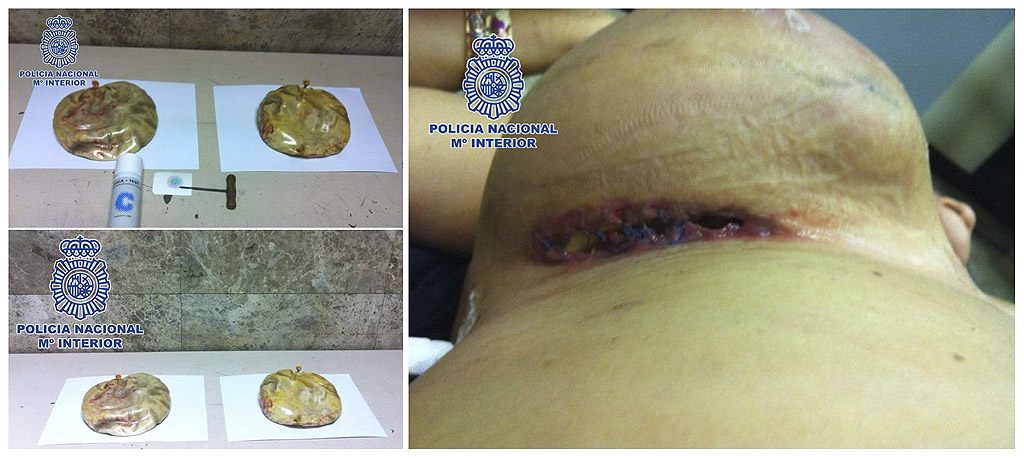 Снимка от Испанската национална полиция на два гръдни импланти, съдържащи кокаин и в гърдите на една жена, която е скрила общо 1,7 кг кокаин в гърдите си. Испанските полицаи арестували венецуелска жена на 43г. когато е пристигнала на международното летище Барахас в Мадрид от Богота, Колумбия