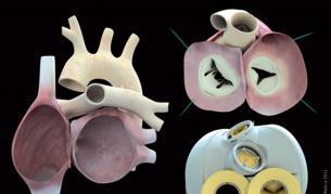 Почина и вторият пациент с изкуствено сърце "Карма"