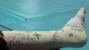 Плевенската зима дари с гипс 26тима