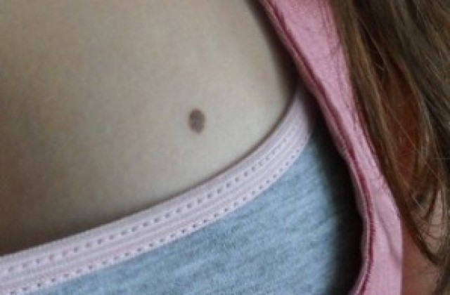 Преглеждат безплатно за рак на кожата