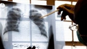 Преглеждат безплатно за туберкулоза