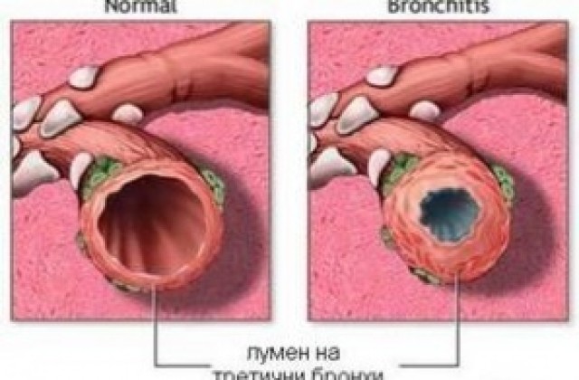 Световен ден за борба с ХОББ