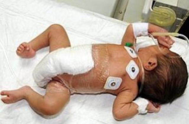 Спасиха живота на бебето с шест крака