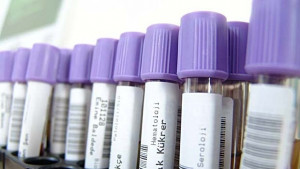 Болните от СПИН у нас са три пъти повече от