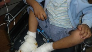 Отрязаха пръсти на малтретирано дете заради гангрена