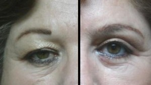 За пластични операции на очите се доверявайте само на хирурзи