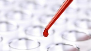 Кръвен тест ще предсказва в ранен стадий болестта на Алцхаймер