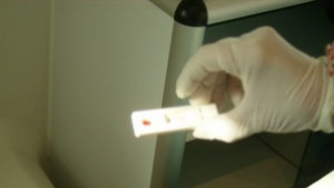 45 годишен мъж от Кюстендил е с диагноза СПИН