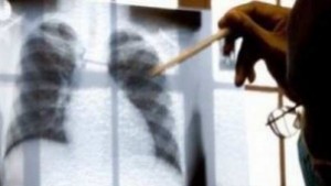 265 пловдивчани се тестваха за туберкулоза трима са заболели