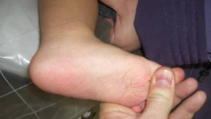 60 от дряновските деца са с проблем на ходилата