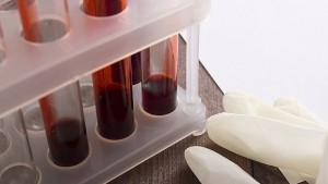 Два нови случая на СПИН в Сливенско