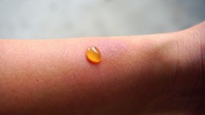 От какво зависи дали едно изгаряне е сериозно