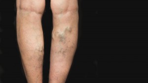 разширени вени