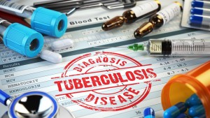 туберкулоза