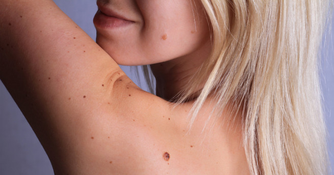 Много хора имат малки тъмни петънца по тялото или лицето