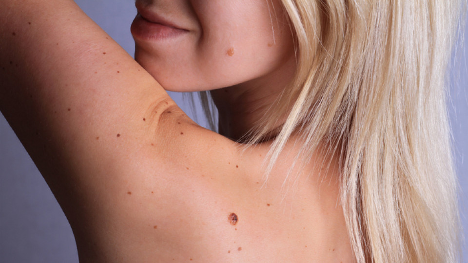 Много хора имат малки тъмни петънца по тялото или лицето