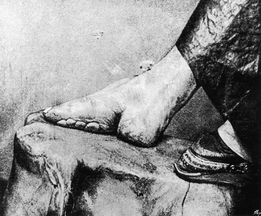 Бинтоване на краката - този обичай днес със сигурност изглежда варварски, но е бил широко разпространен в Китай до 1911 г., когато е бил официално забранен. Краката на малки момичета, най-вече от благородни семейства, са били здраво бинтовани, което деформирало цялото ходило и пръсти. В резултат на това растежът на ходилото спира и то приема формата на „лотос“, което се считало за особено атрактивно. Много момичета са се превърнали в инвалиди и не са можели да ходят без помощ, но са имали по-голям шанс да се омъжат.
<p> </p>