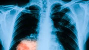 белодробен рак