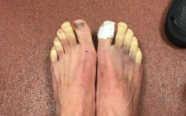 Какво се случи с краката на Адам Лалана?