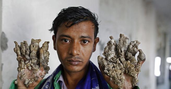 Абул Баджандар от Бангладеш, който стана известен като човека дърво заради