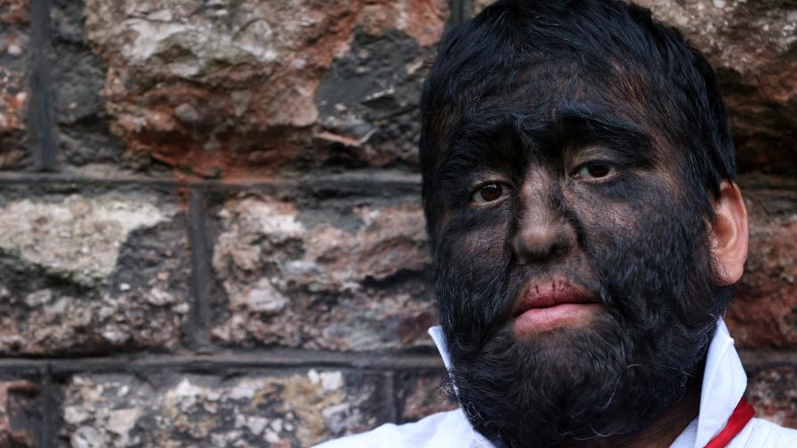  Деца получиха „ синдрома на върколака ” поради лекарство 