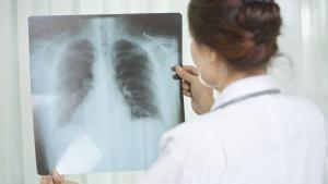 Ръст на скритата заболеваемост от туберкулоза заради пандемията от COVID 19