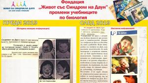 Синдром на Даун