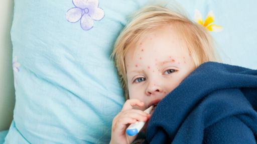  Бум на варицела в цялата страна 