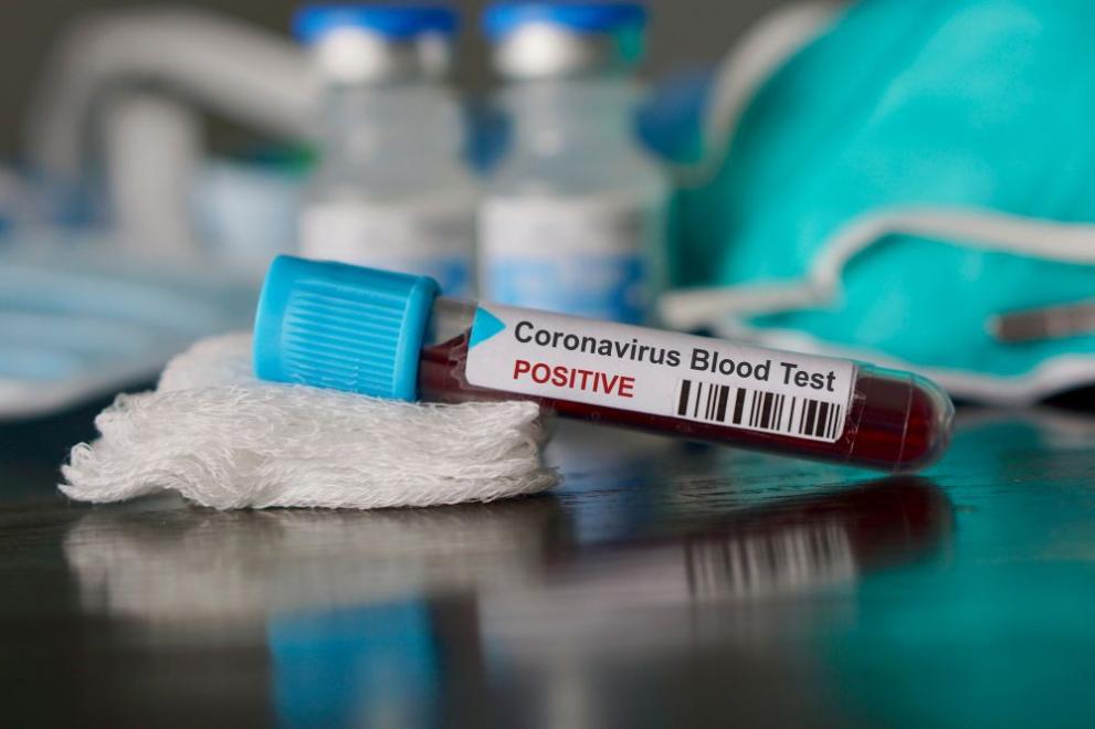 Преболедувалите коронавирусната инфекция рискуват пост-COVID синдром