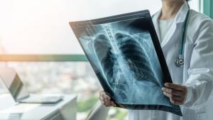 рентгенова снимка бели дробове