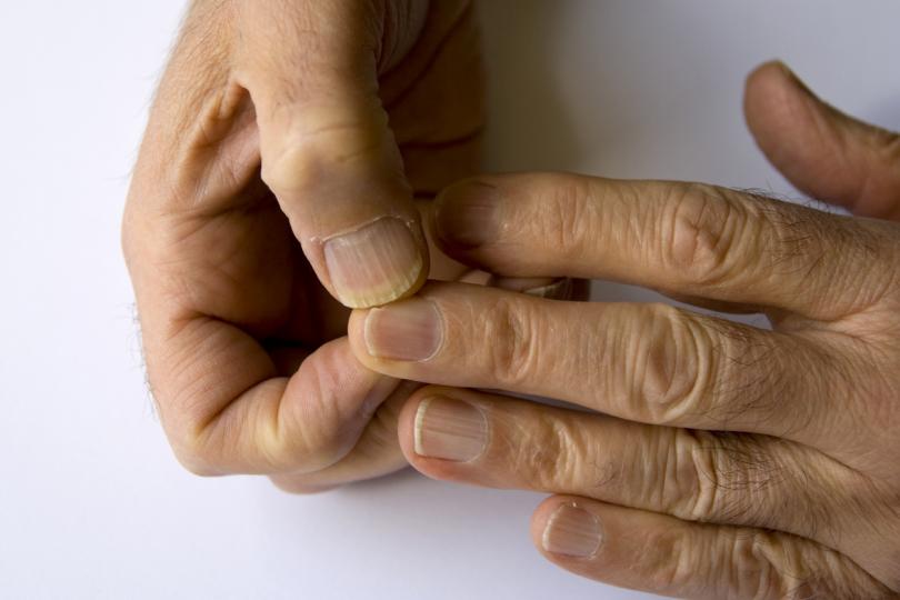 <p><strong>Жълти/пожълтели нокти</strong></p>

<p>Една от най-често срещаните причини за жълти нокти е появата на гъбична инфекция. Тъй като инфекцията се влошава, нокътното легло може да се прибере, ноктите да се удебелят и да започнат да се ронят. В редки случаи жълтите нокти могат да бъдат показател за по-сериозно състояния като тежко заболяване на щитовидната жлеза, белодробно заболяване, диабет или псориазис.</p>