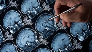 Болестта на Алцхаймер тихо опустошава мозъка дълго преди появата на