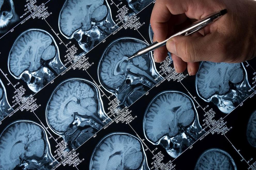 Болестта на Алцхаймер тихо опустошава мозъка дълго преди появата на