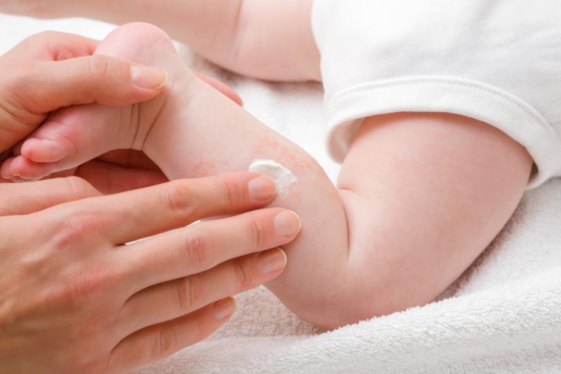 5 често срещани обрива по крачетата на бебето