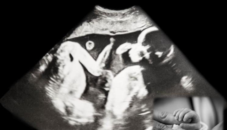 близнаци - ЧУДО: Жена с две матки роди близначета - по едно във всяка
