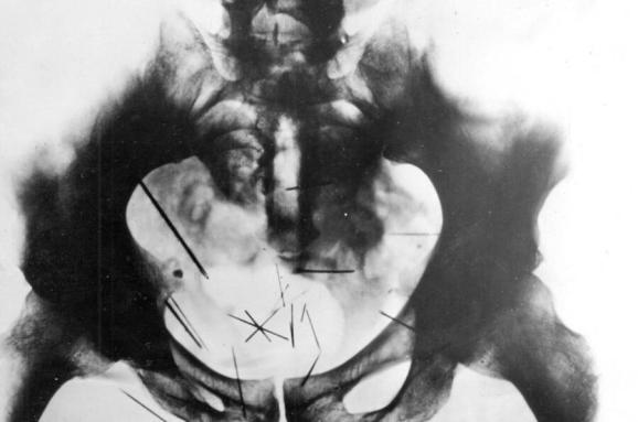  Рентгенова фотография на таза на Фиш с 29 игли, забодени в него 