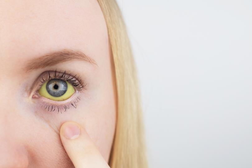 <p><strong>Жълтеникави очи</strong></p>

<p>Ако бялата част пожълтее, то е много вероятно да имате проблеми с черния дроб, затова незабавно потърсете лекарска помощ. Пожълтелите очи могат да са симптом на жълтеница или алкохолизъм.</p>