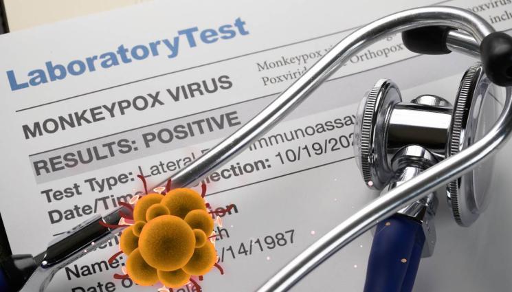 Маймунска шарка - ЗАПЛАХАТА РАСТЕ: СЗО откри над 90 случая на маймунска шарка в 12 страни