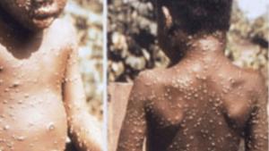 От Центъра по заразни и паразитни болести НЦЗПБ разпространиха актуална информация