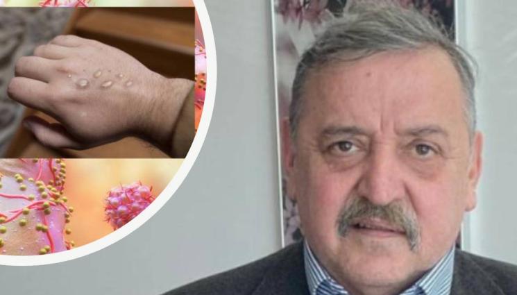 кантарджиев маймунска шарка - СЛЕД ПЛЪЗВАНЕТО НА ЗАРАЗАТА У НАС: Маймунската шарка не плаши Кантарджииев, притеснява се от друго (Вижте опасението на професора)