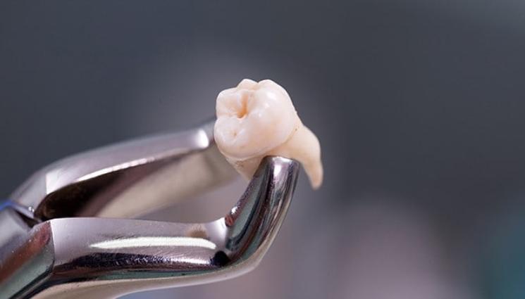 зъболекари зъби клещи - КРИЗА НА ОСТРОВА: Глад за стоматолози в Англия, хората вадят сами зъбите си с клещи. Кабинетите масово хлопнали кепенци заради пандемията