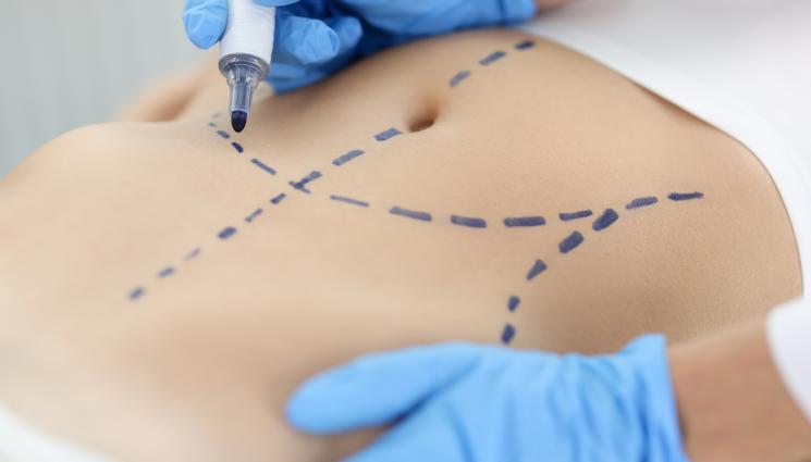 кожа операция - ЗЛАТНО ВРЕМЕ: Втора кожа лепва върху увредената