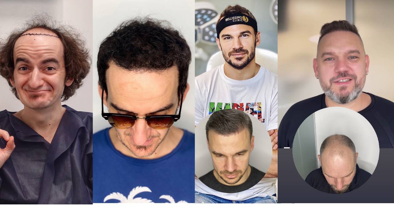 присадени коси Ники Станоев Ивайло Захариев Иво Моллов Гугутката